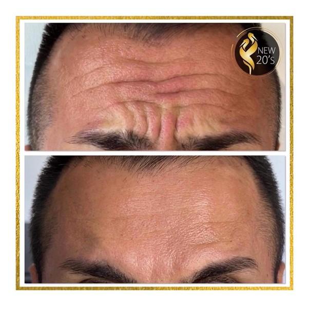 Before and after botox treatment