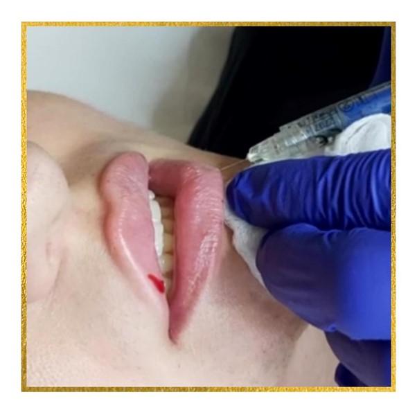 Lips filler injection