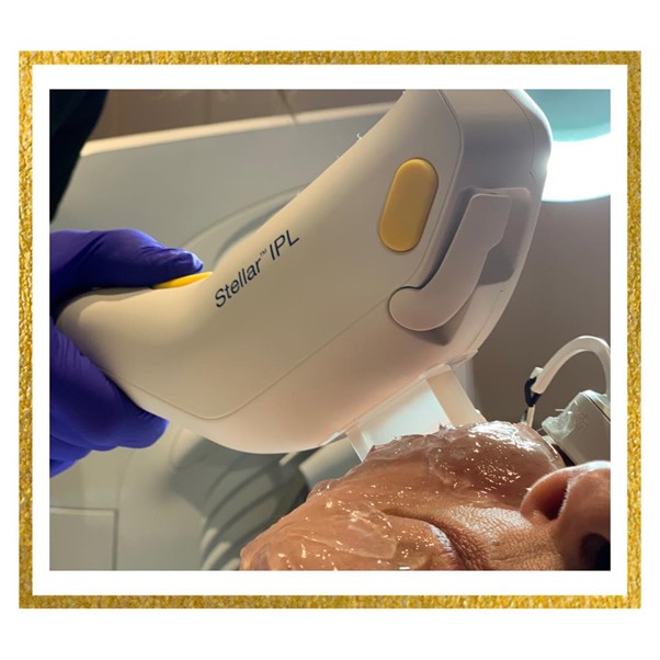 Stellar IPL face treatment